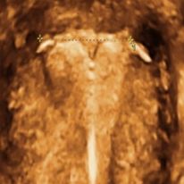 IUD1