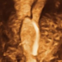 IUD2