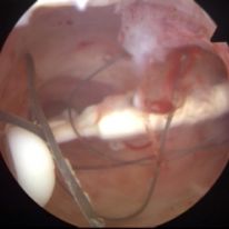 IUD-03