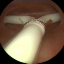 IUD-06