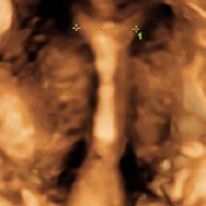 IUD-GF-11