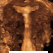IUD-GF-12