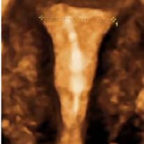 IUD-GF-13