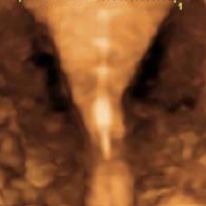 IUD-GF-14