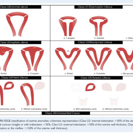 ESHRE classification of congenital anomalies of the uterus