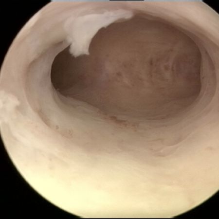 Uterine Cavity Uterine Cavity